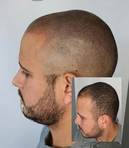 Thinking Of Scalp Micropigmentation?