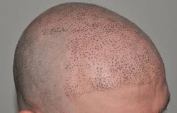 bad scalp micropigmentation