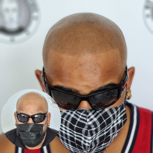 Scalp Micropigmentation Client Ballajura Perth Wa