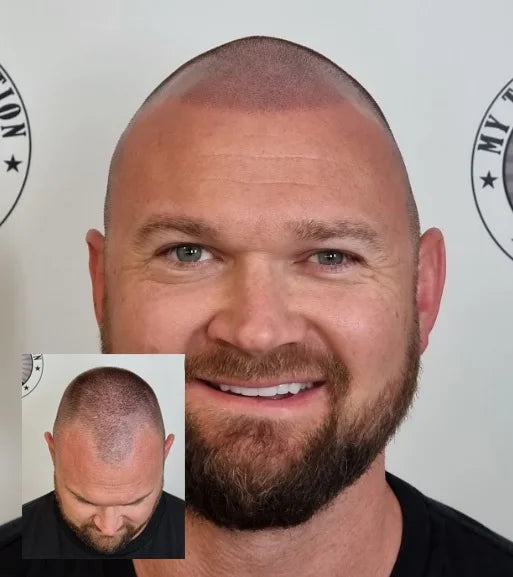 Scalp Micropigmentation Clients Tapping Perth Wa