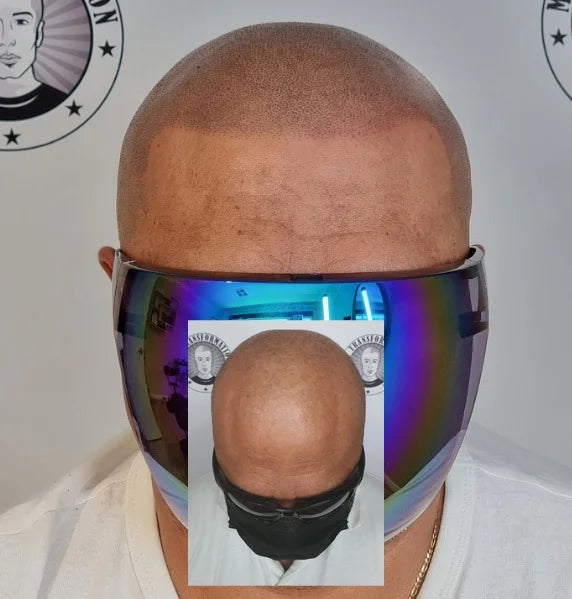Scalp Micropigmentation Client Brabham Perth Wa