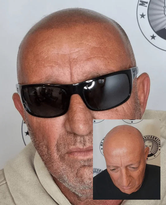 Scalp Micropigmentation Ashby Perth Wa