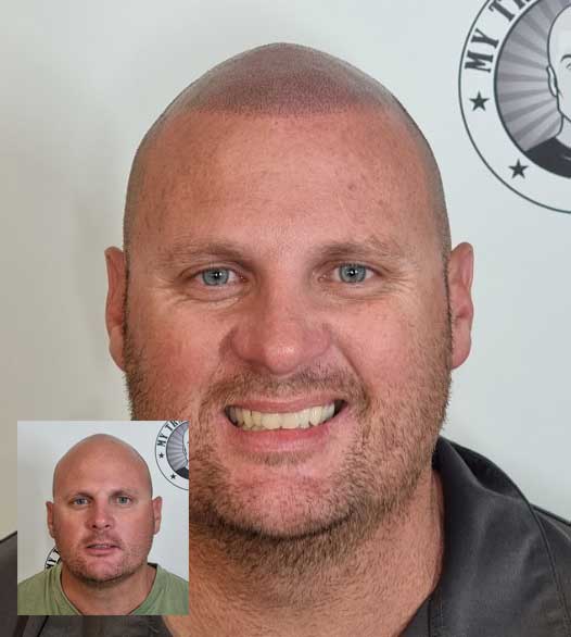 Scalp Micropigmentation Client Currambine Perth Wa
