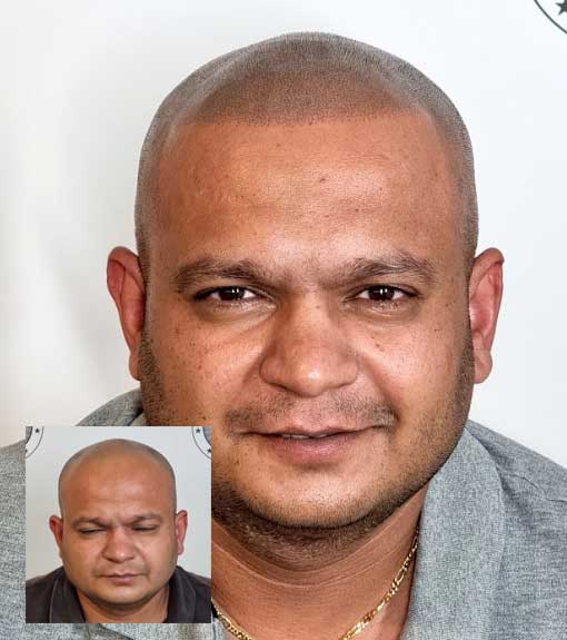 Scalp Micropigmentation Geraldton Perth Wa