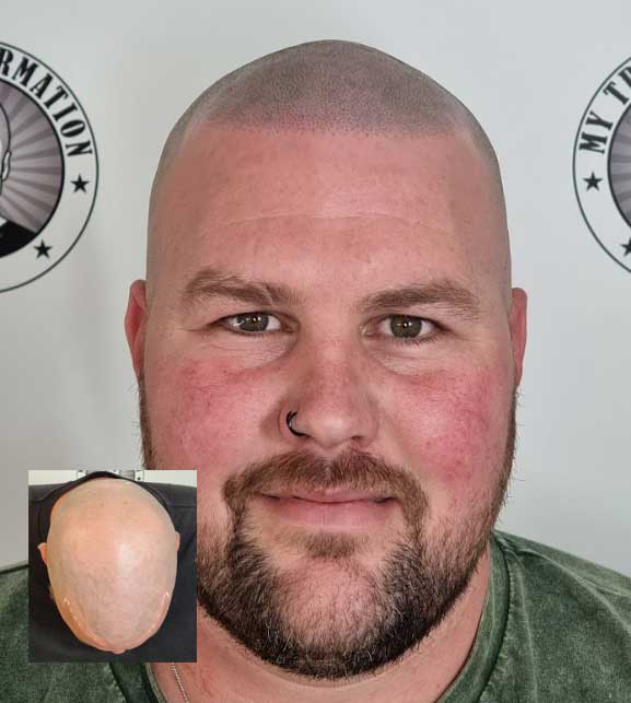 Scalp Micropigmentation Hillary’s Perth WA