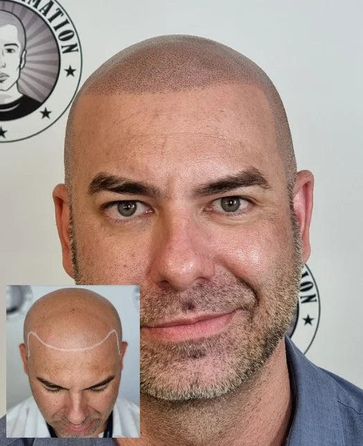 Scalp Micropigmentation North Beach Perth Wa