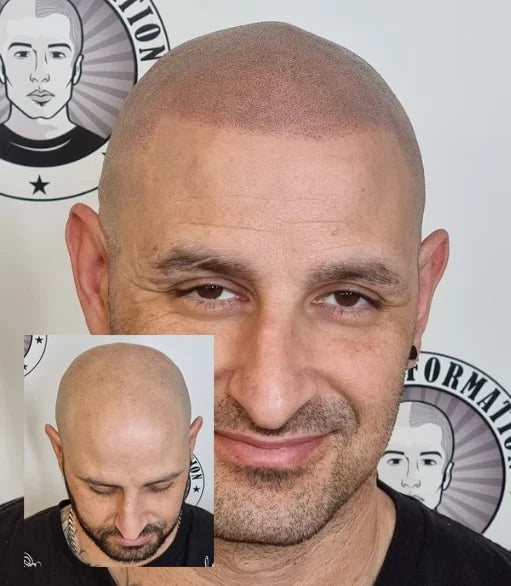 Scalp Micropigmentation Client Banskia Grove Perth Wa