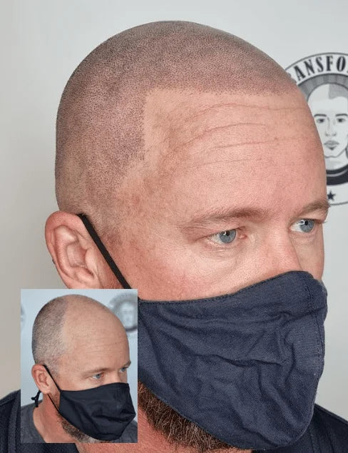 Scalp Micropigmentation Client Dunsborough Perth Wa