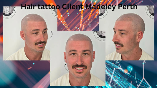 Scalp Micropigmentation Client Madeley Perth