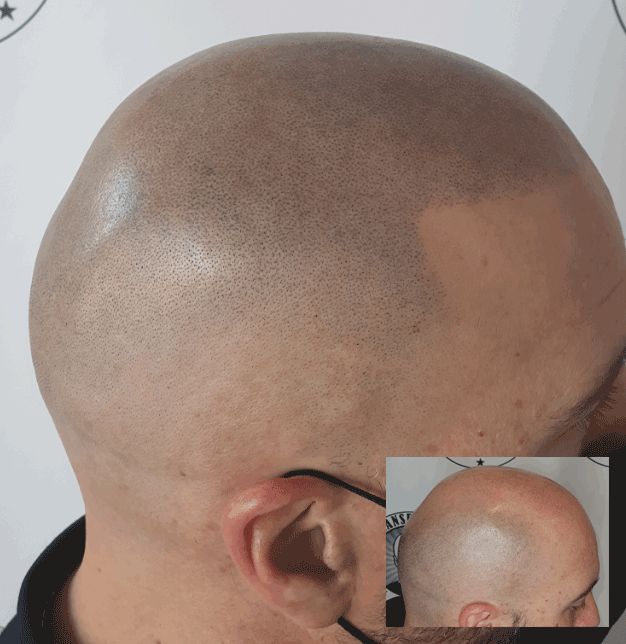 Scalp Micropigmentation Client From Yokine Perth WA