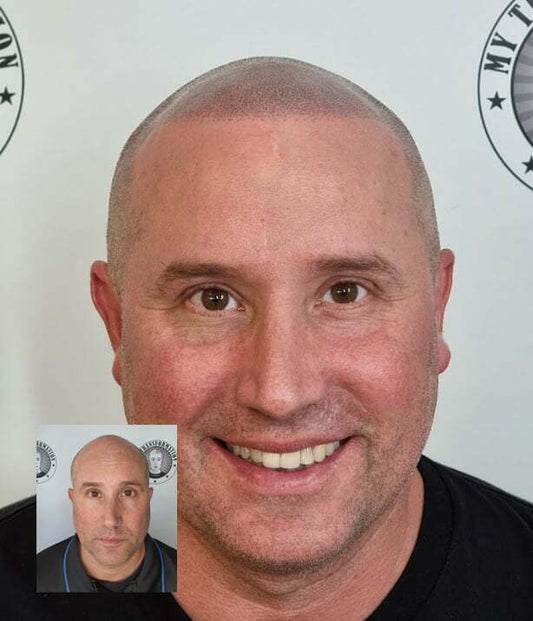 Scalp Micropigmentation Mirrabooka Perth Wa