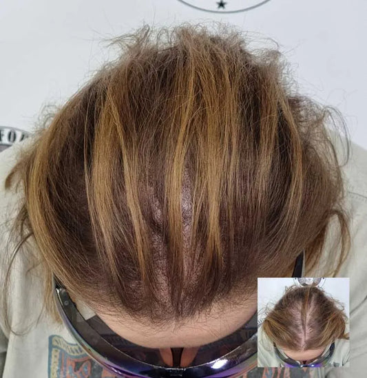 Treat Women’s Hair-loss – Scalp Micropigmentation