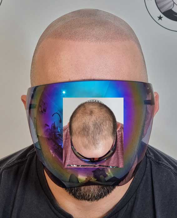 Scalp Micropigmentation Mount Pleasant Perth Wa