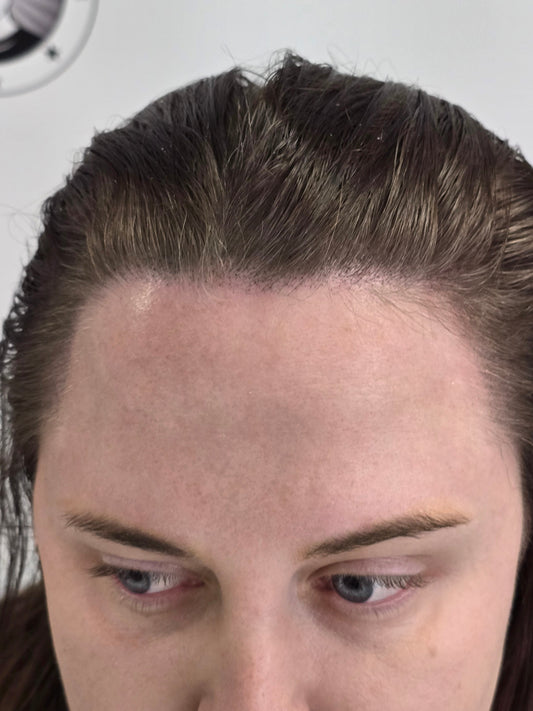 Women's Hairline Density - Hair Thinning Solution Perth