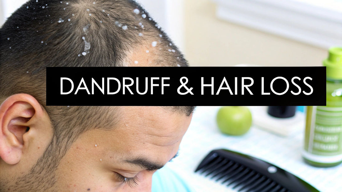 Does Dandruff Cause Hair Loss? Unpacking The Truth