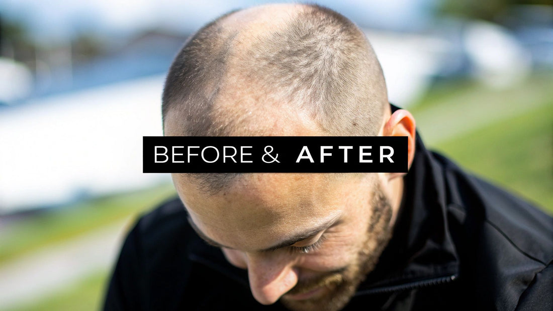 6 Stunning Scalp Micropigmentation Before After Results (2025)