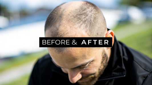 6 Stunning Scalp Micropigmentation Before After Results (2025)