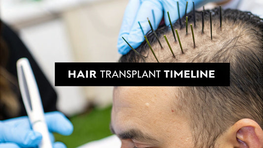 Your Complete Hair Transplant Timeline From Day 1 to Final Results