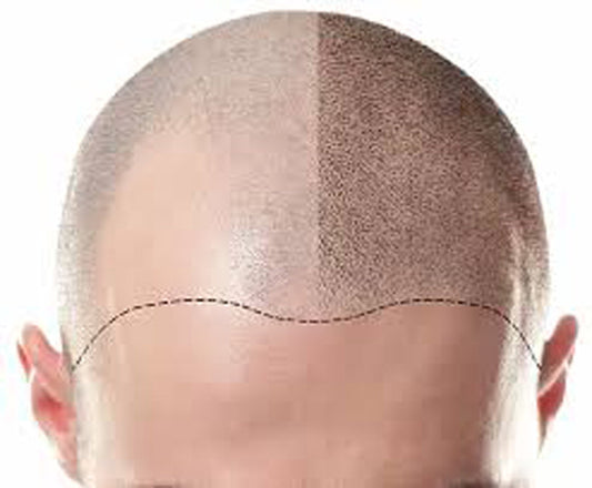 How To Prepare For Scalp Micropigmentation Treatment