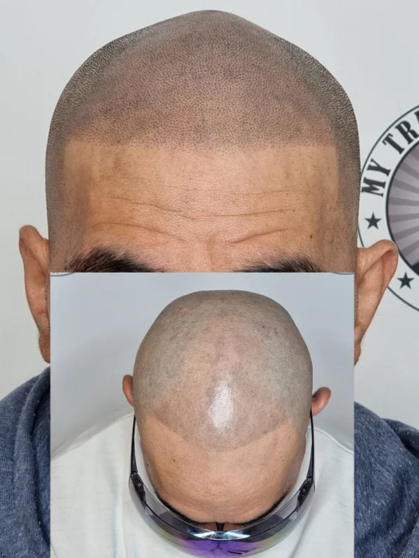 Scalp Micropigmentation Munster Perth Wa