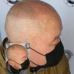 My Transformation, Scalp Micropigmentation Perth, Hair Tattoo Perth, SMP Perth, SMP WA, Perth Australia