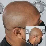 My Transformation, Scalp Micropigmentation Perth, Hair Tattoo Perth, SMP Perth, SMP WA, Perth Australia