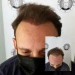 My Transformation, Scalp Micropigmentation Perth, Hair Tattoo Perth, SMP Perth, SMP WA, Perth Australia