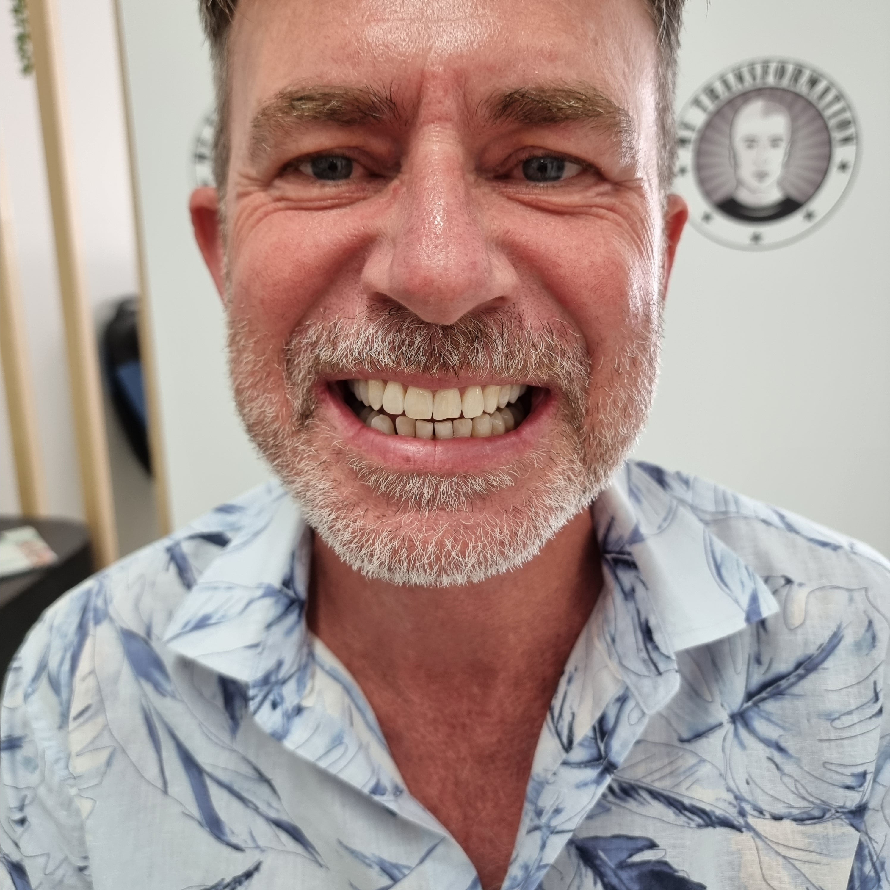 My Transformation, Teeth Witening Perth, Cosmetic Whitening, Instantley A Whiter Smile, Affordable Cosmetic Teeth Whitening,