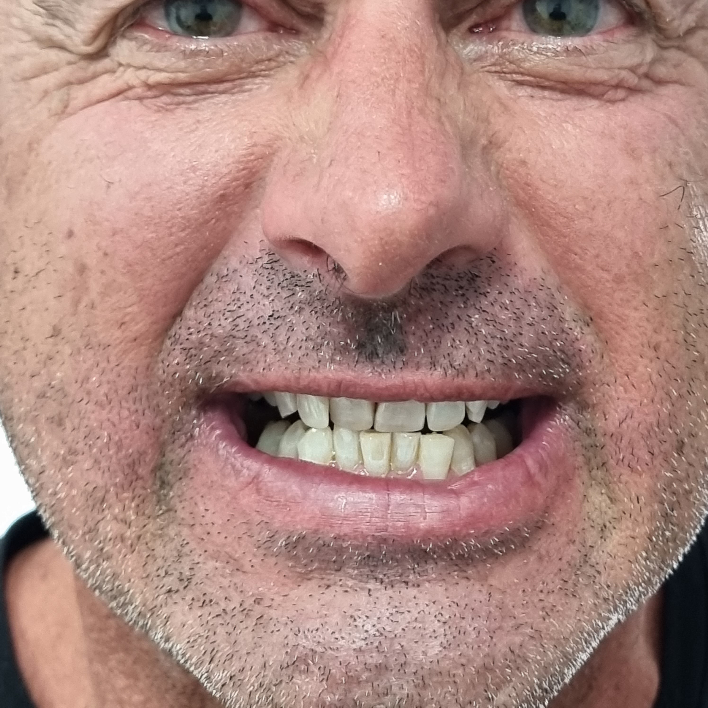 My Transformation, Teeth Witening Perth, Cosmetic Whitening, Instantley A Whiter Smile, Affordable Cosmetic Teeth Whitening,