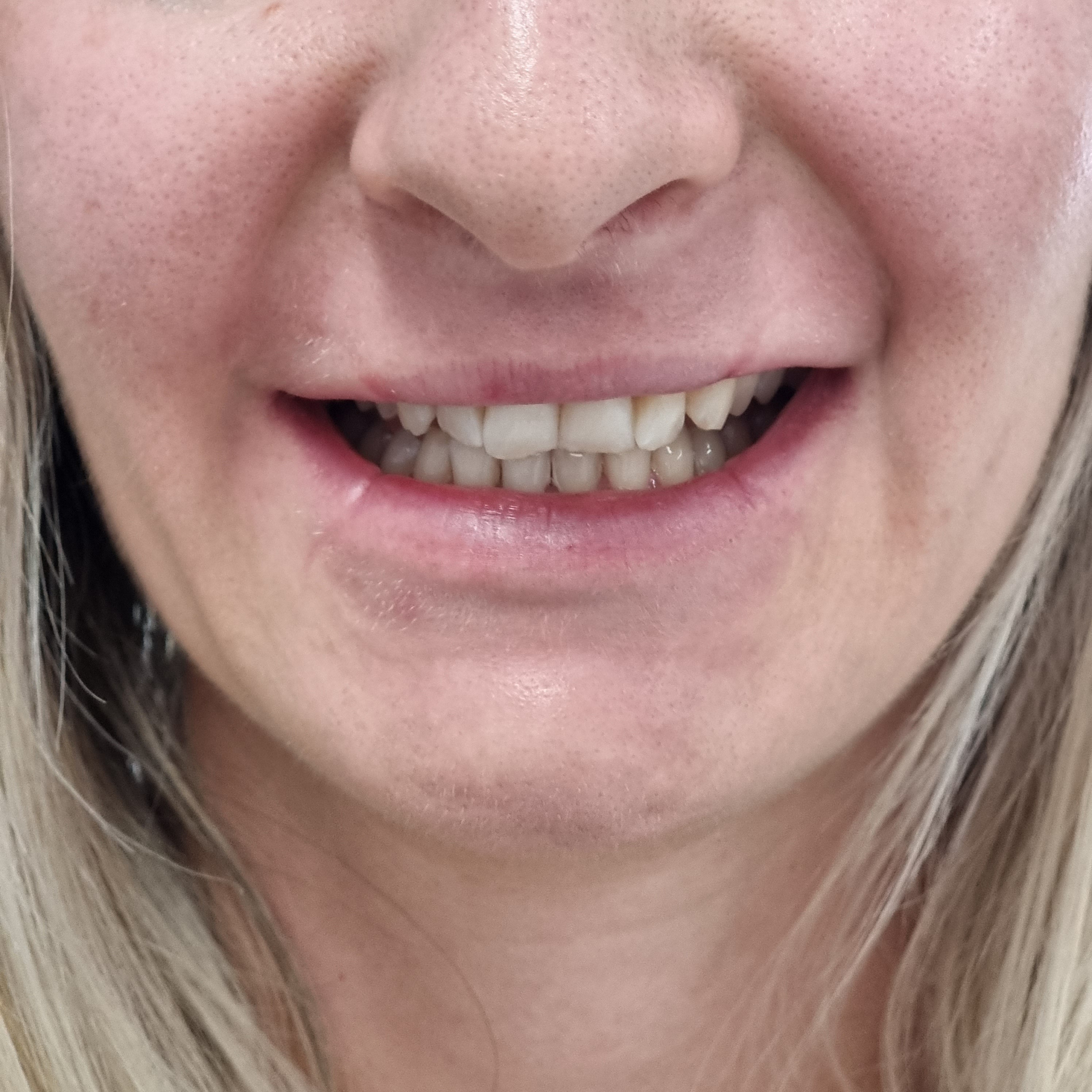 My Transformation, Teeth Witening Perth, Cosmetic Whitening, Instantley A Whiter Smile, Affordable Cosmetic Teeth Whitening,