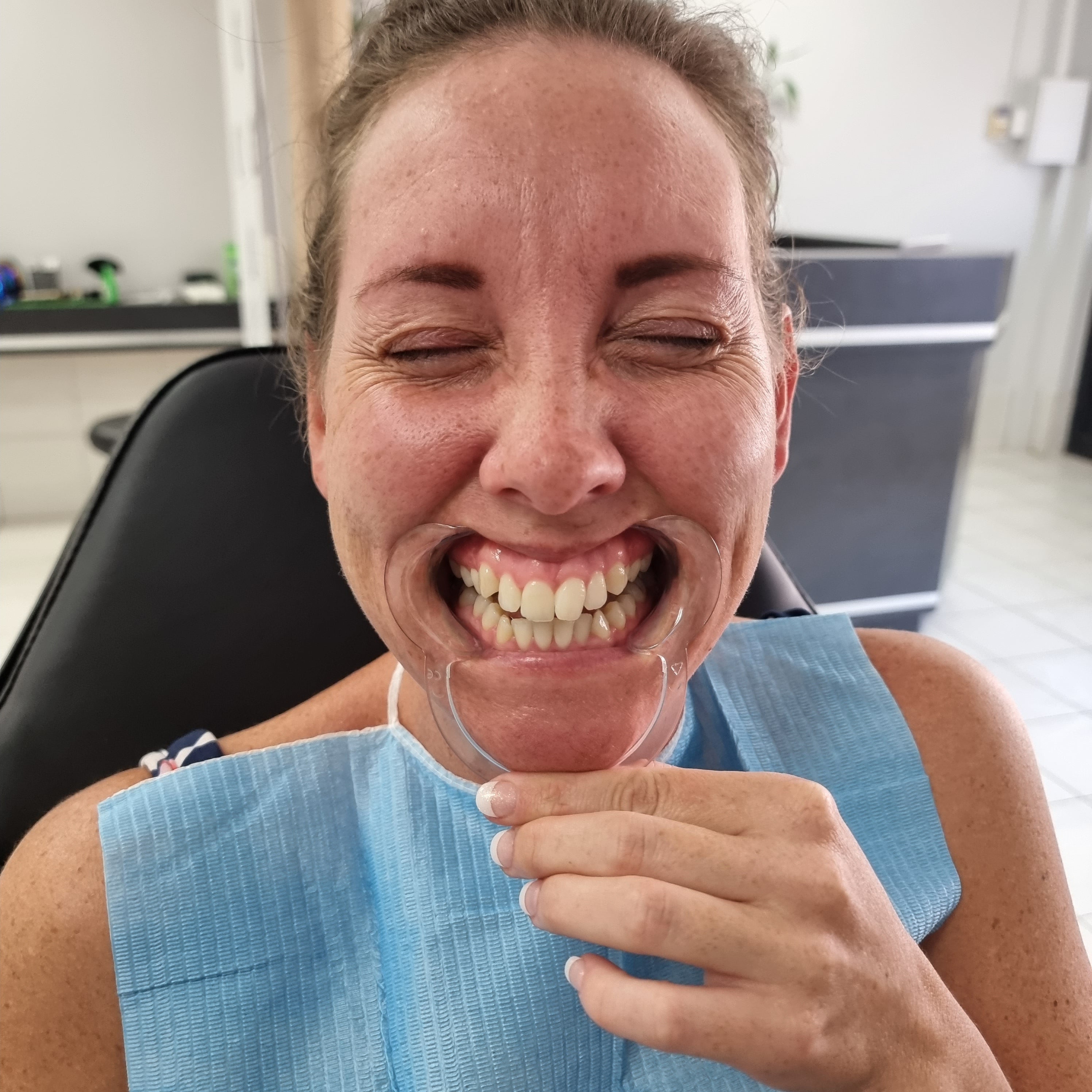 My Transformation, Teeth Witening Perth, Cosmetic Whitening, Instantley A Whiter Smile, Affordable Cosmetic Teeth Whitening,