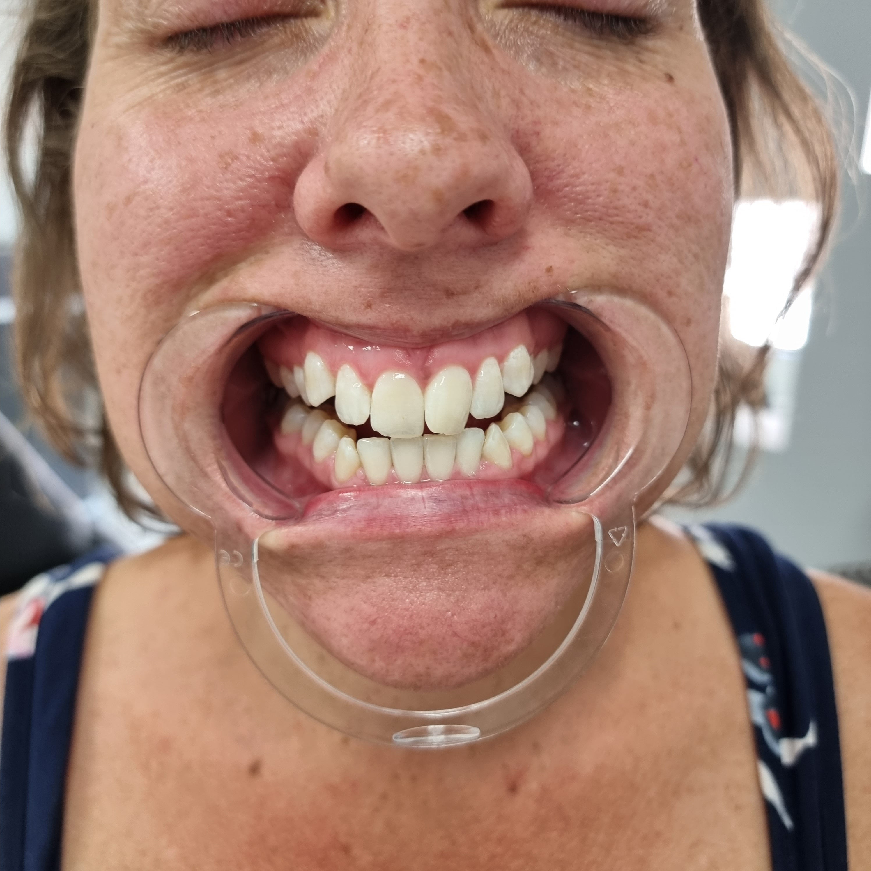 My Transformation, Teeth Witening Perth, Cosmetic Whitening, Instantley A Whiter Smile, Affordable Cosmetic Teeth Whitening,