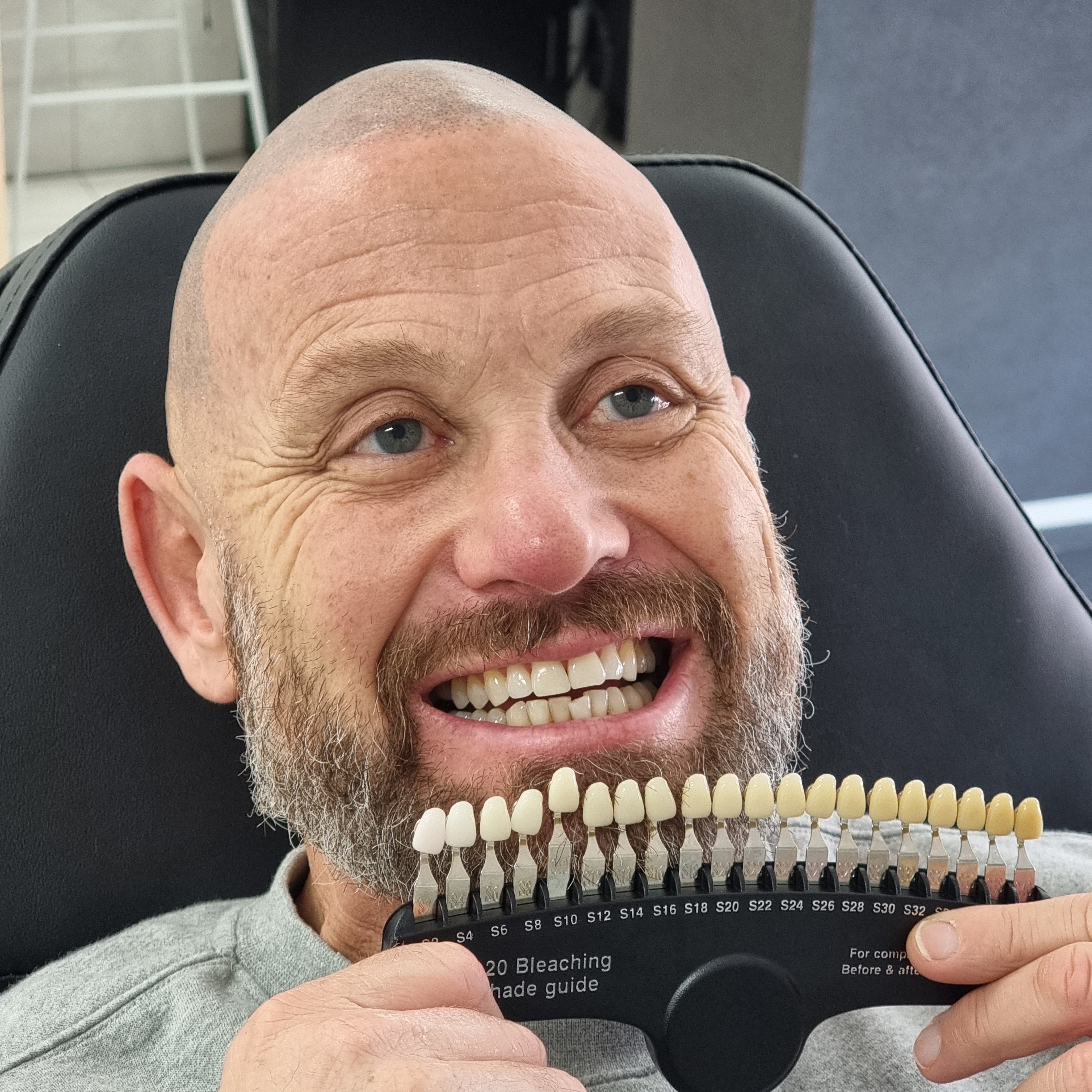 My Transformation, Teeth Witening Perth, Cosmetic Whitening, Instantley A Whiter Smile, Affordable Cosmetic Teeth Whitening,