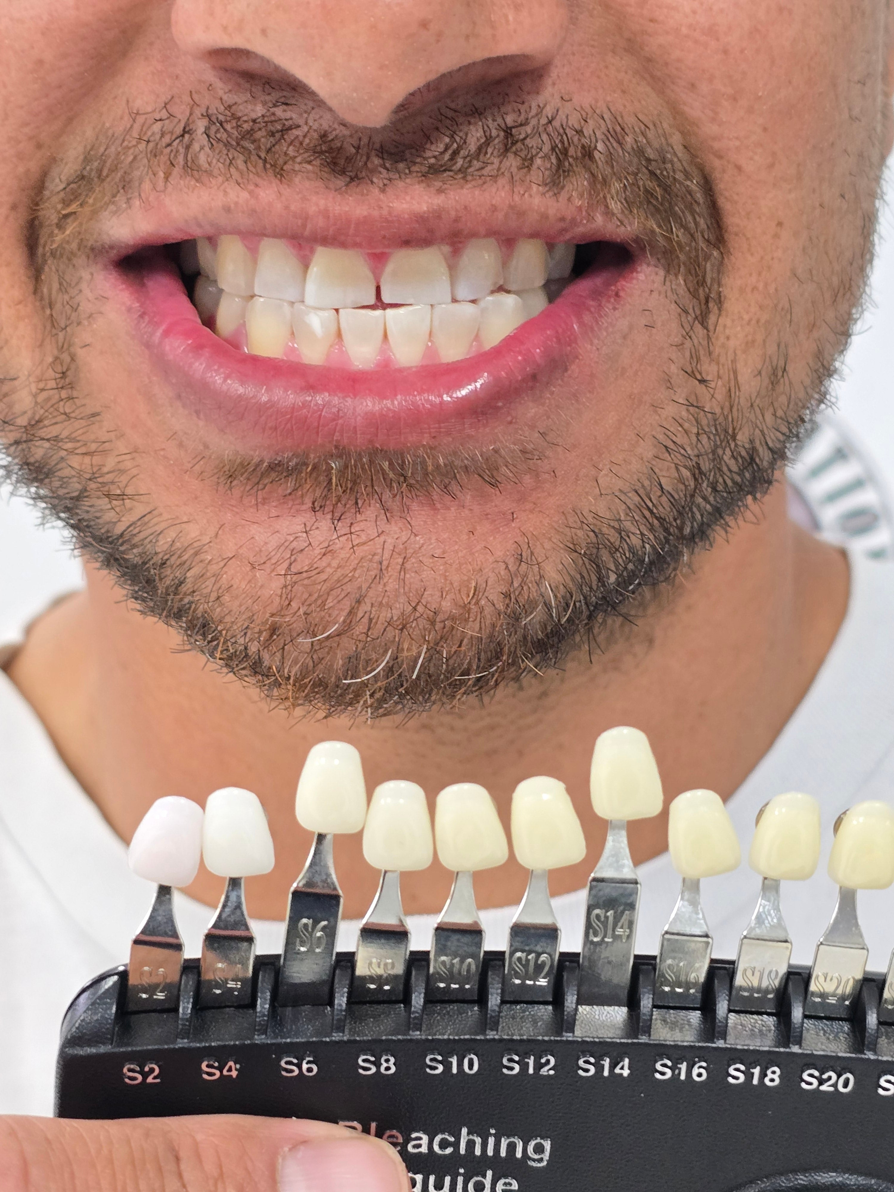 My Transformation, Teeth Witening Perth, Cosmetic Whitening, Instantley A Whiter Smile, Affordable Cosmetic Teeth Whitening,