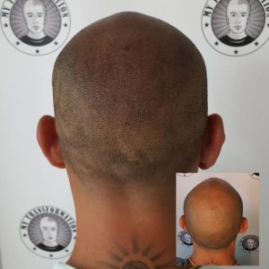 My Transformation, Scalp Micropigmentation Perth, Hair Tattoo Perth, MP Perth, SMP WA, Perth Australia