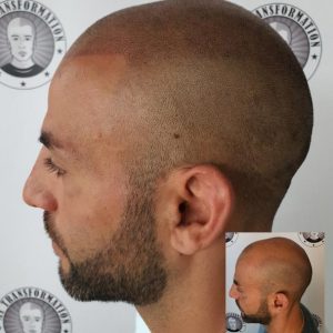 My Transformation, Scalp Micropigmentation Perth, Hair Tattoo Perth, MP Perth, SMP WA, Perth Australia