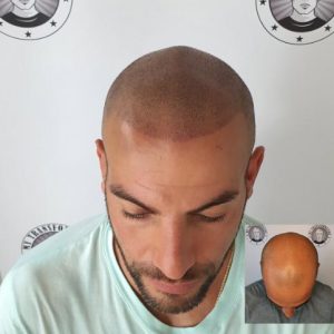 My Transformation, Scalp Micropigmentation Perth, Hair Tattoo Perth, MP Perth, SMP WA, Perth Australia