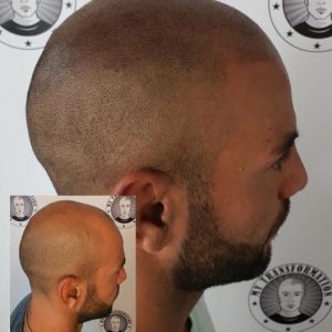 My Transformation, Scalp Micropigmentation Perth, Hair Tattoo Perth, MP Perth, SMP WA, Perth Australia