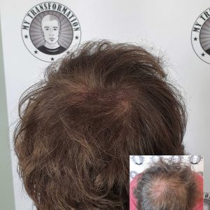 My Transformation, Scalp Micropigmentation Perth, Hair Tattoo Perth, MP Perth, SMP WA, Perth Australia