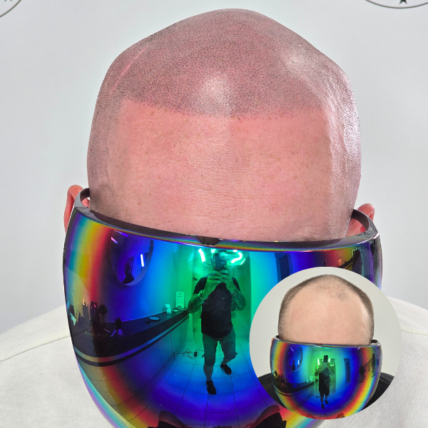 My Transformation, Scalp Micropigmentation Perth, Hair Tattoo Perth, MP Perth, SMP WA, Perth Australia