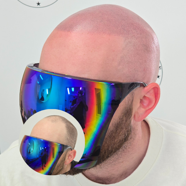 My Transformation, Scalp Micropigmentation Perth, Hair Tattoo Perth, MP Perth, SMP WA, Perth Australia