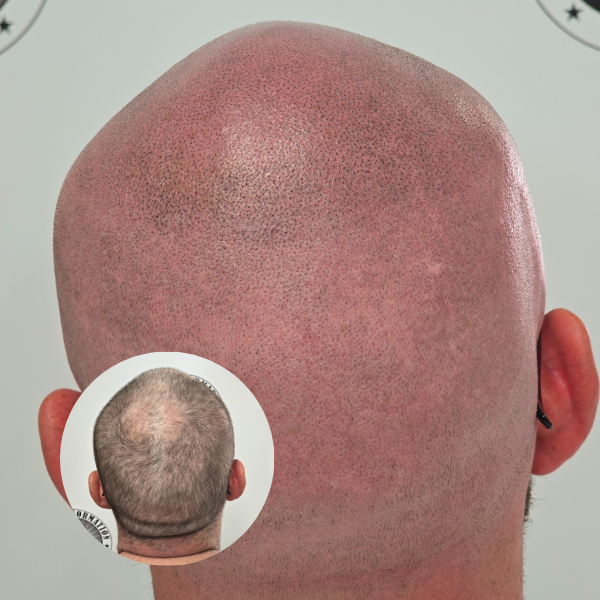My Transformation, Scalp Micropigmentation Perth, Hair Tattoo Perth, MP Perth, SMP WA, Perth Australia