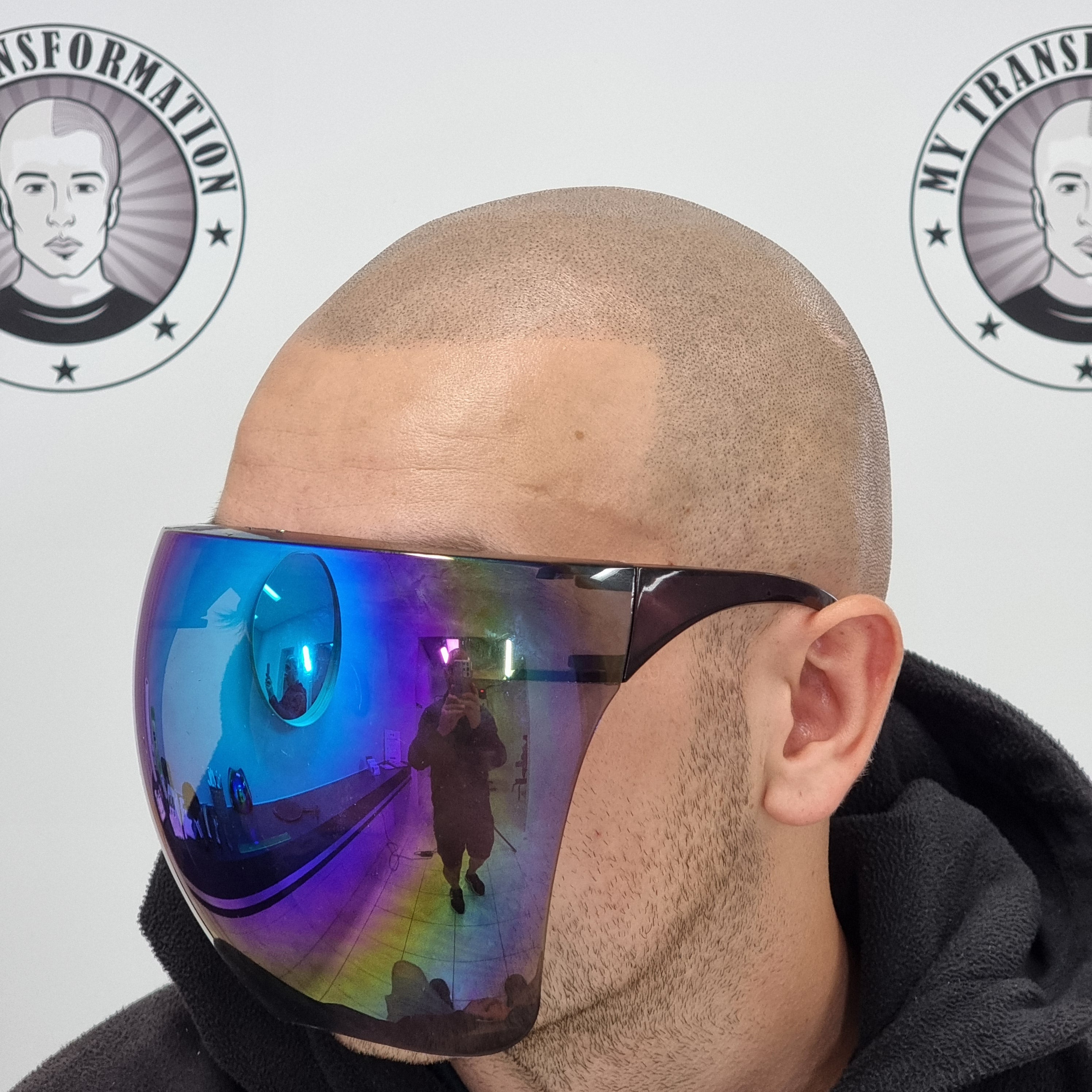 My Transformation, Scalp Micropigmentation Perth, Hair Tattoo Perth, SMP Perth, SMP WA, Perth Australia, Men's hair Tattoo