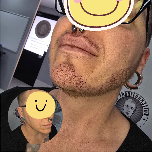 My Transformation, Beard Micropigmentation Perth, Hair Tattoo Perth, SMP Perth, SMP WA, Perth, Australia, Men's hair Tattoo, SMP in action, Scalp Micropigmentation