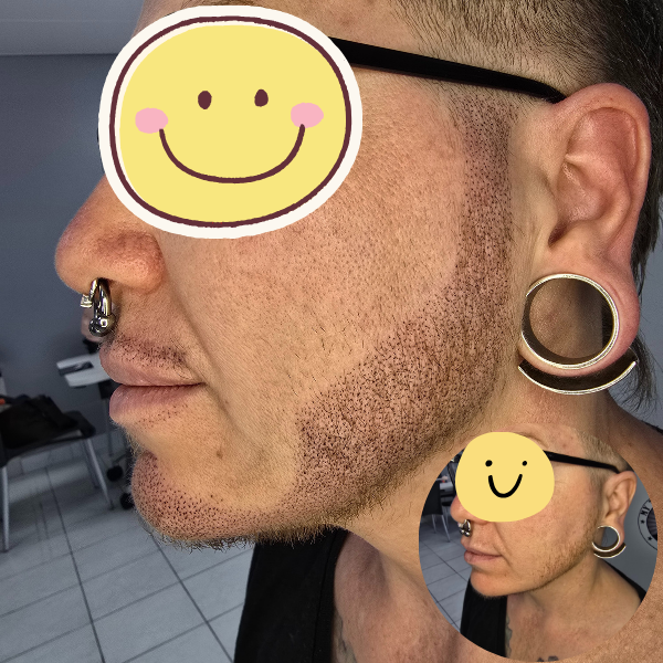 My Transformation, BeardMicropigmentation Perth, Hair Tattoo Perth, SMP Perth, SMP WA, Perth, Australia, Men's hair Tattoo, SMP in action, Scalp Micropigmentation