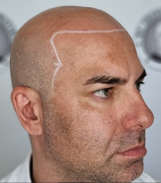 My Transformation, Scalp Micropigmentation Perth, Hair Tattoo Perth, MP Perth, SMP WA, Perth Australia