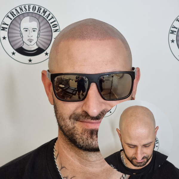 My Transformation, Scalp Micropigmentation Perth, Hair Tattoo Perth, MP Perth, SMP WA, Perth Australia
