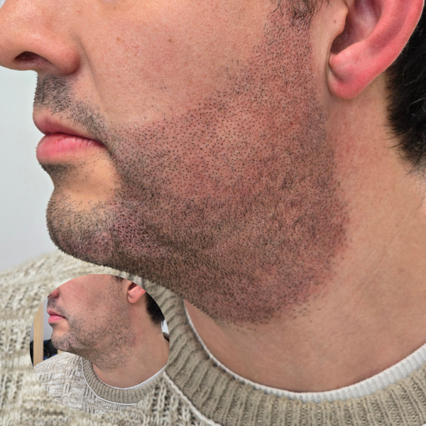 My Transformation, Beard Micropigmentation Perth, Hair Tattoo Perth, SMP Perth, SMP WA, Beard Tattoo