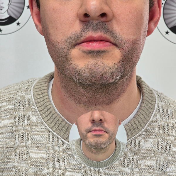 My Transformation, Beard Micropigmentation Perth, Hair Tattoo Perth, SMP Perth, SMP WA, Beard Tattoo