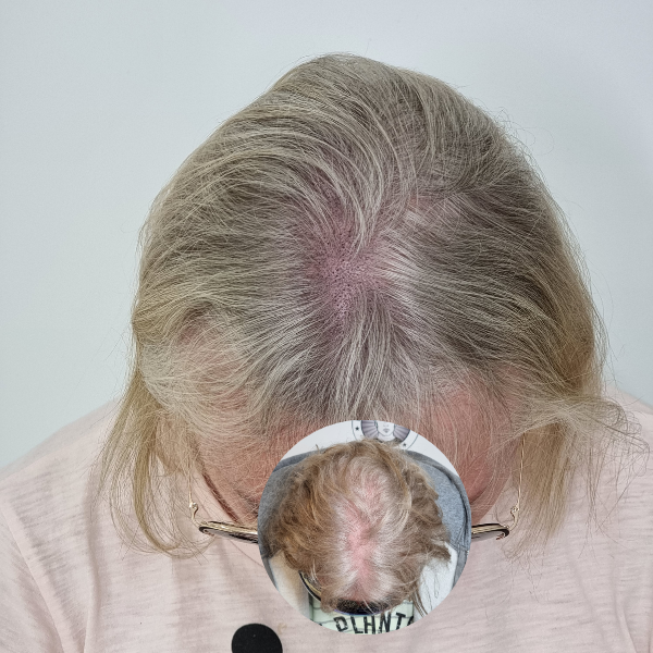 My Transformation,, Women's Hair Tattoo Perth, SMP Perth, SMP WA, Sclp Micropigmentation For Women